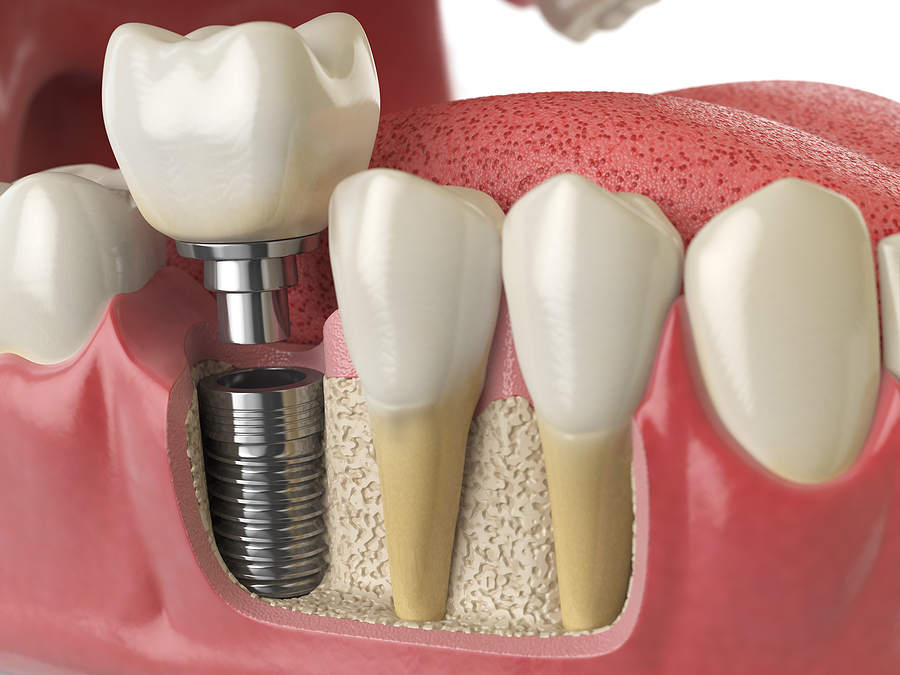 Restore Your Smile with Dental Implants in Hollywood, CA